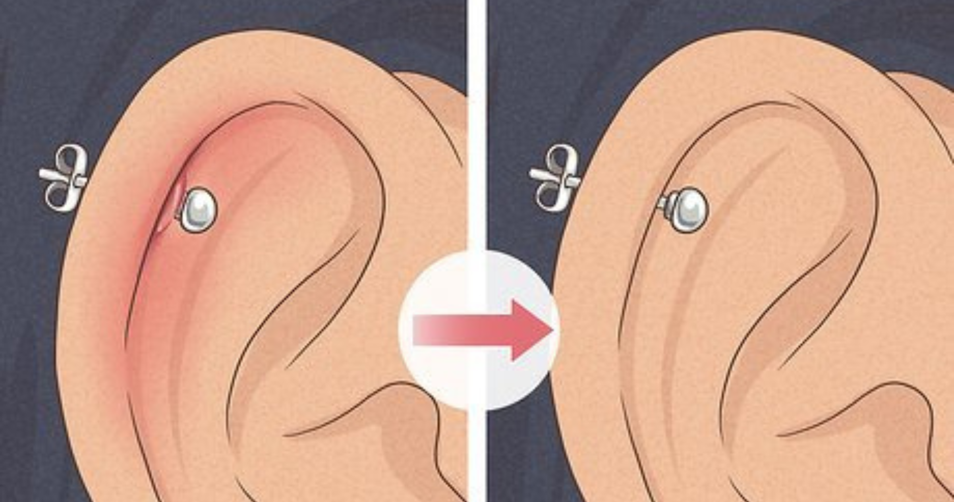 Chéloïdes après un piercing ? Traitement et préventions Joyaux Piercing